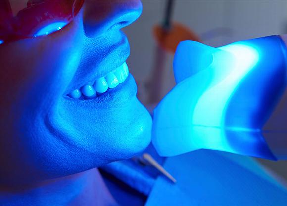 teeth whitening in studio